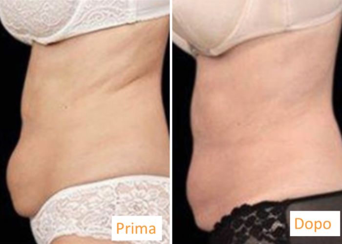 Emsculpt addome - aureal (2)