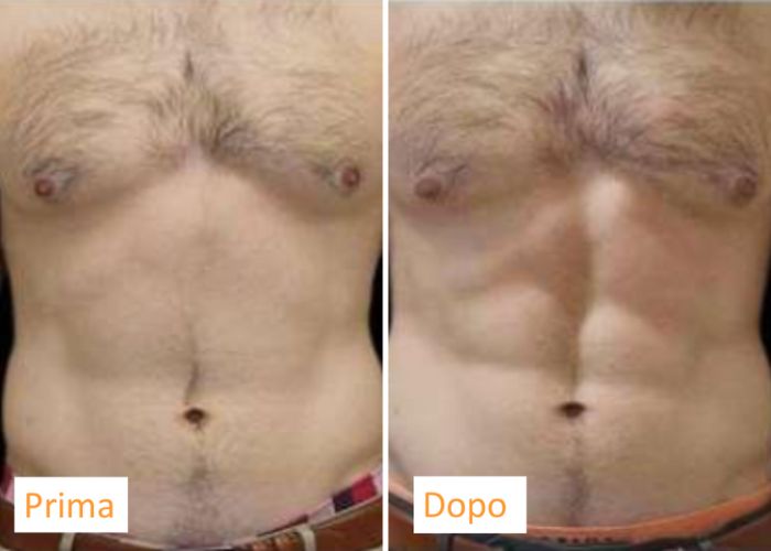 Emsculpt addome - aureal (3)