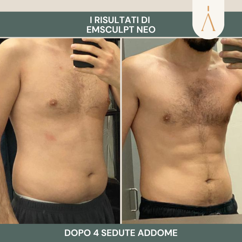 emsculpt 1