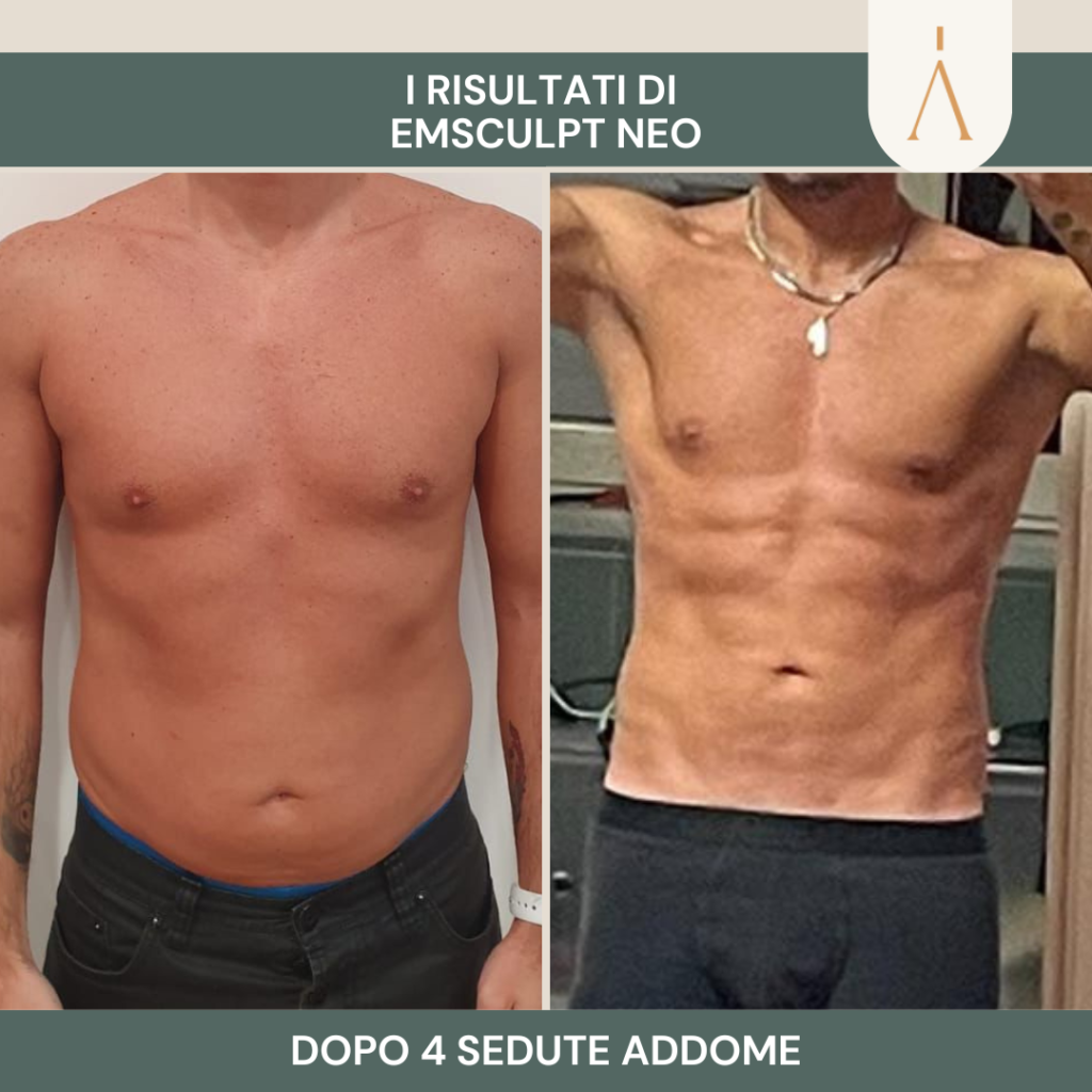 emsculpt 2