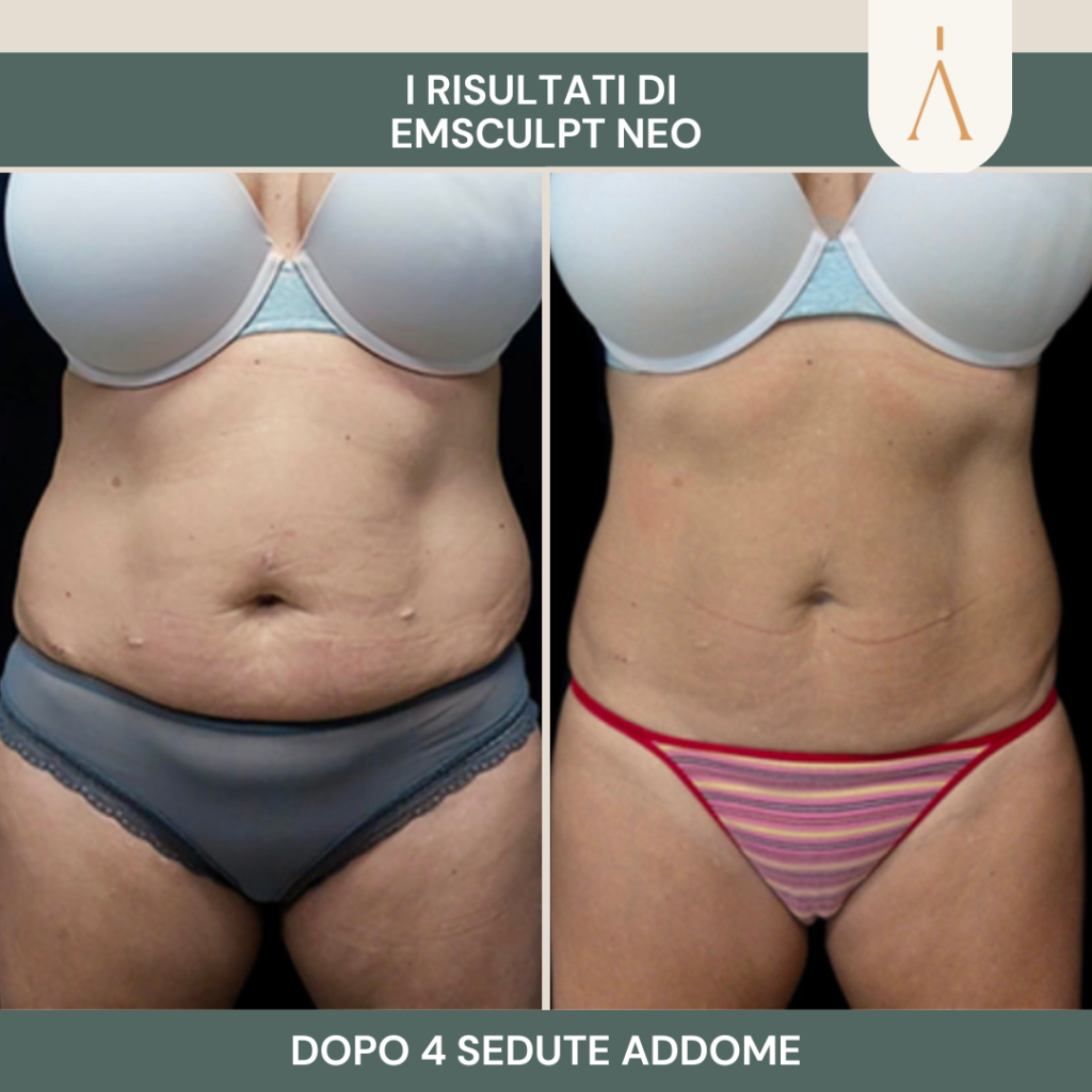 emsculpt 2 (2)