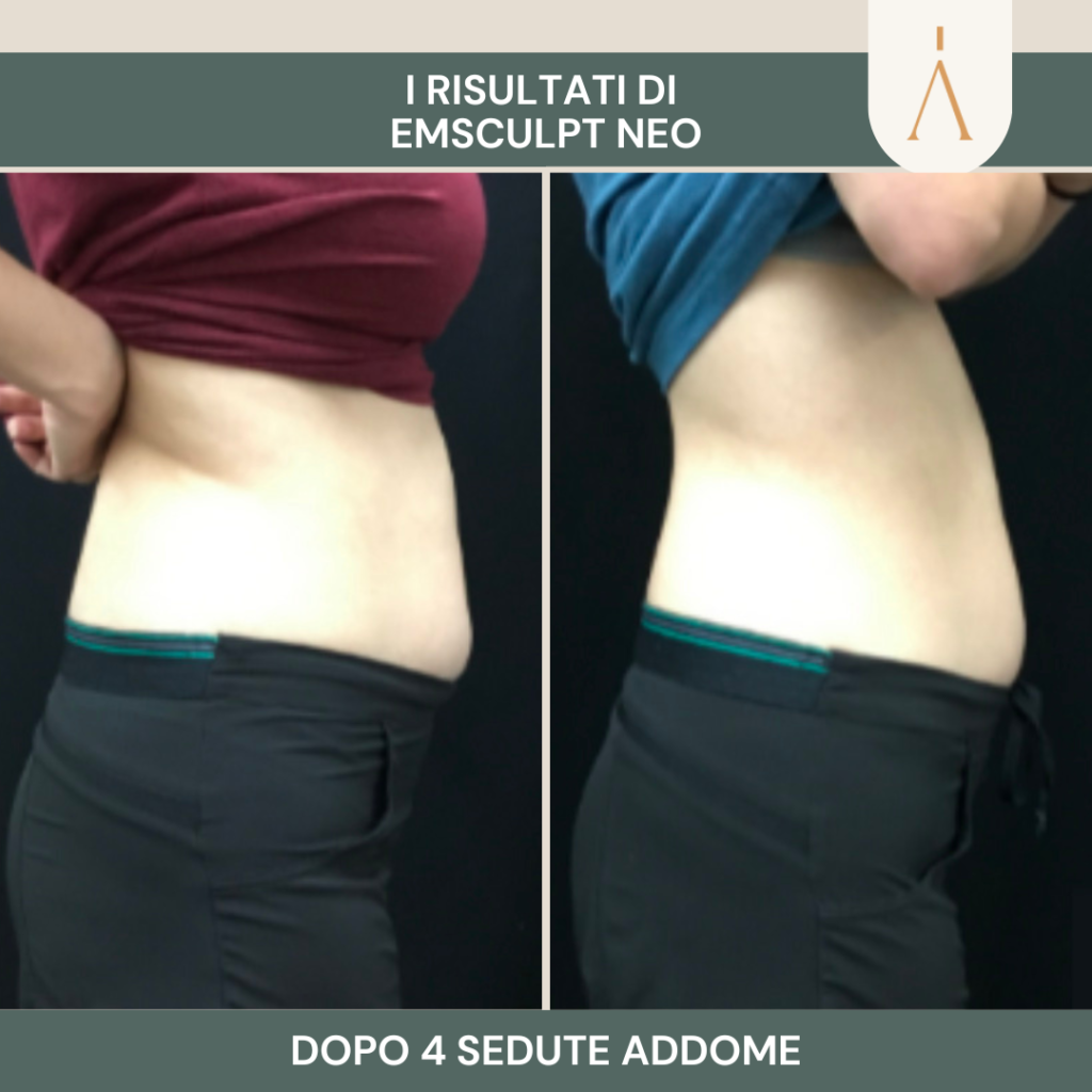 emsculpt 2 (3)