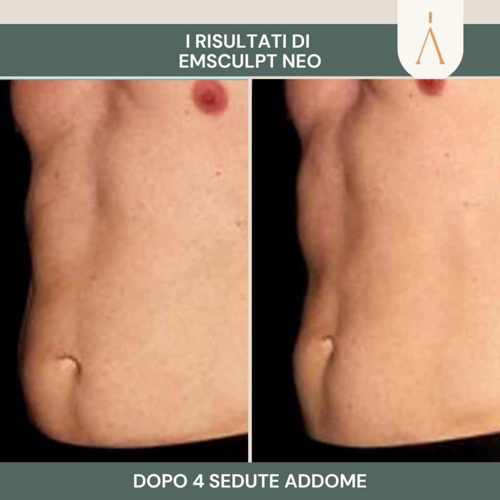 emsculpt 2 (4)