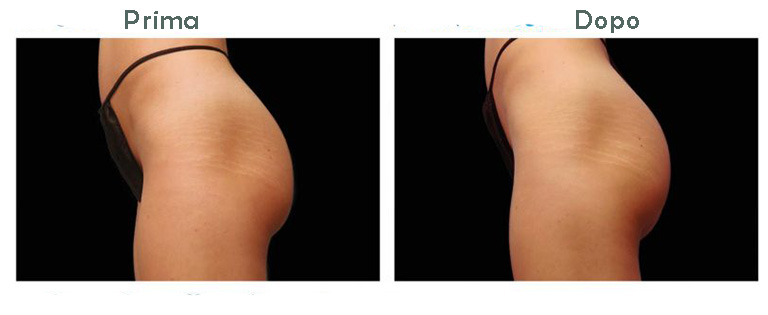 glutei