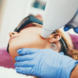 Laser Resurfacing non ablativo