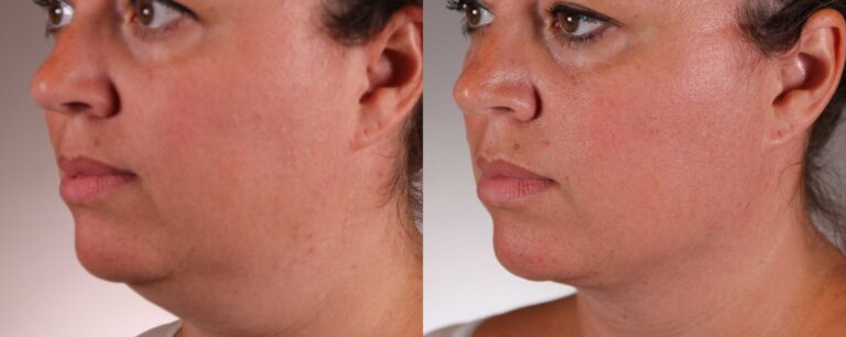 FaceTite_CS1_1120