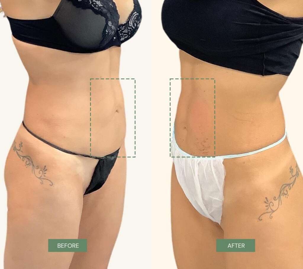 Coolsculpting addome donna (2)