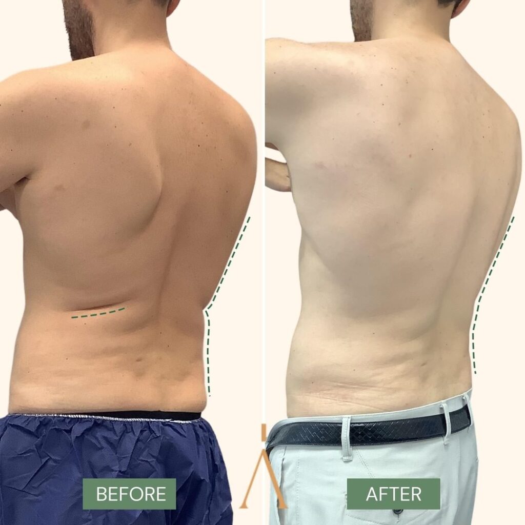 Coolsculpting uomo back